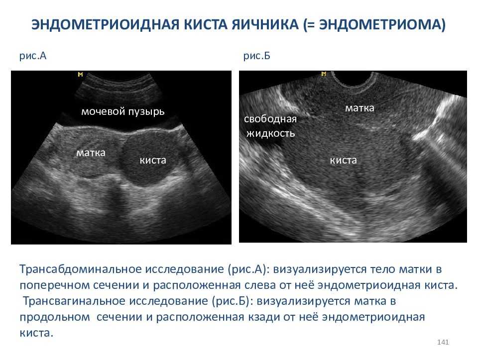 Возможности визуализации и ультразвуковая картина матки и придатков в норме