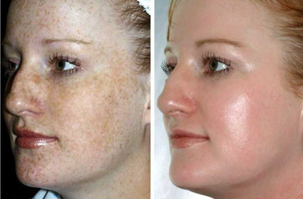 Как восстанавливается кожа. Лазерная наноперфорация постакне. Пигментация на лице до и после. Химический пилинг.