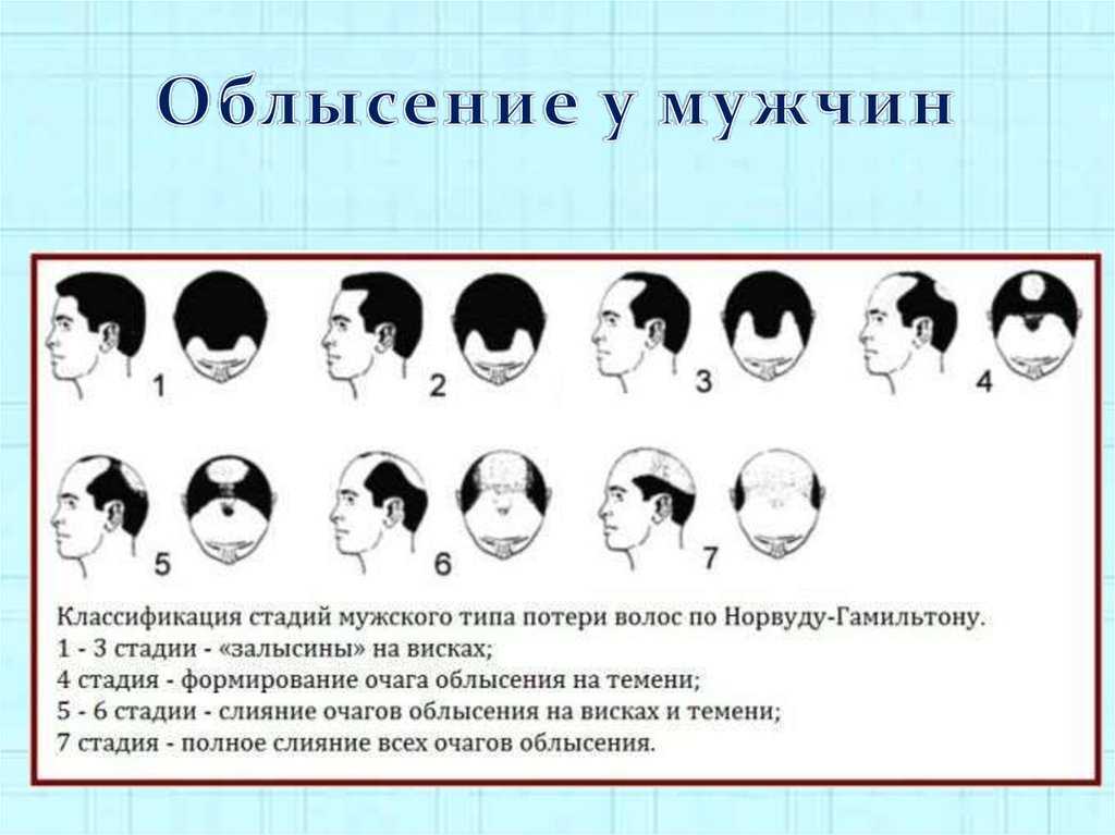 Стадии мужчин. Облысение классификация. Стадии облысения на картинках. Стадии облысения у мужчин. Классификация типов облысения.