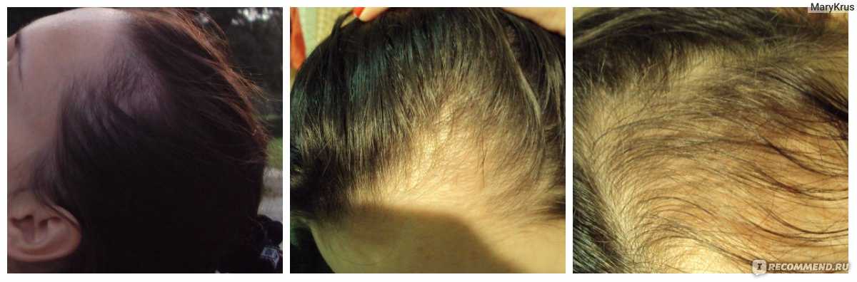 Ковид волосы выпадают что делать. Послеродовое выпадение волос. Выпадение волос до и после. Выпадение волос при отращивании. Выпадение волос после родов.