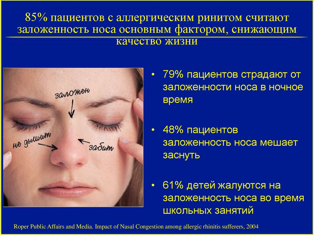 Причины заболевания носа. Аллергические риносинусопатии. Проявления аллергического ринита. Аллергическая реакция на лице.