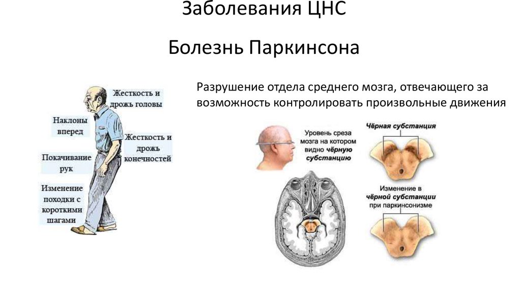 Хроническое заболевание мозга. Поражение структур мозга при болезни Паркинсона. Отделы поражения мозга при болезни Паркинсона. Хронические заболевания ЦНС список. При болезни Паркинсона поражается структура мозга:.