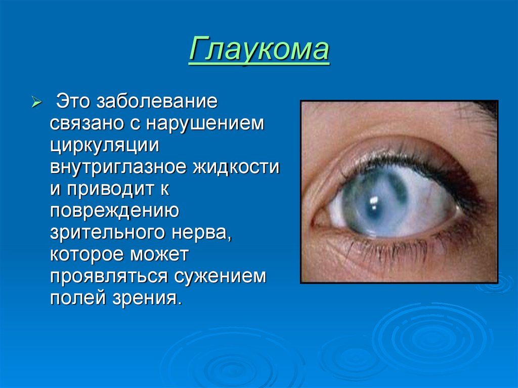 Заболевания глаз биология 8. Сообщение о заболеваниях глаз. Глазные болезни презентация. Заболевание глаз глаукома.