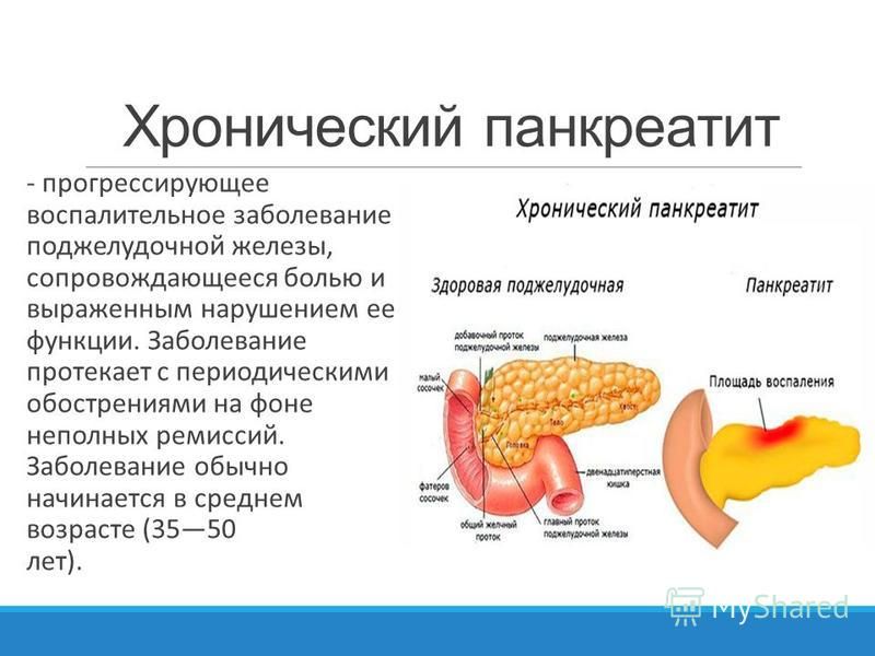 Заболевания поджелудочной железы панкреатиты