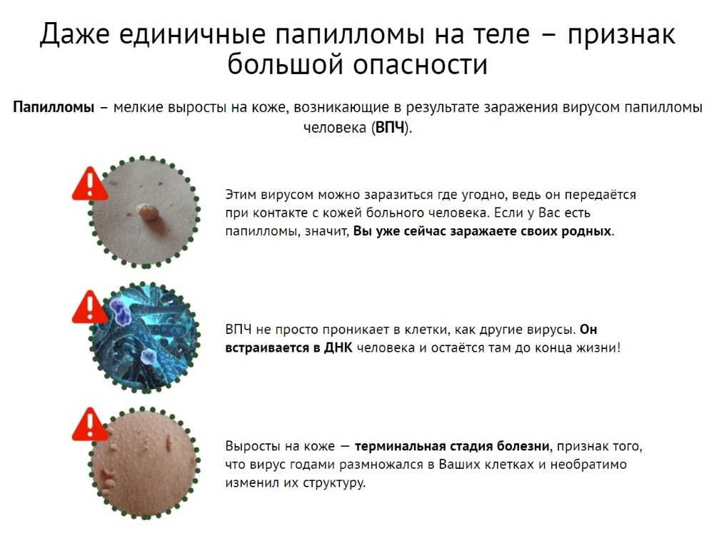 Папиломы вирус передается чем лечить. ВПЧ как выглядит вирус. Вирус папилломы человека на теле.