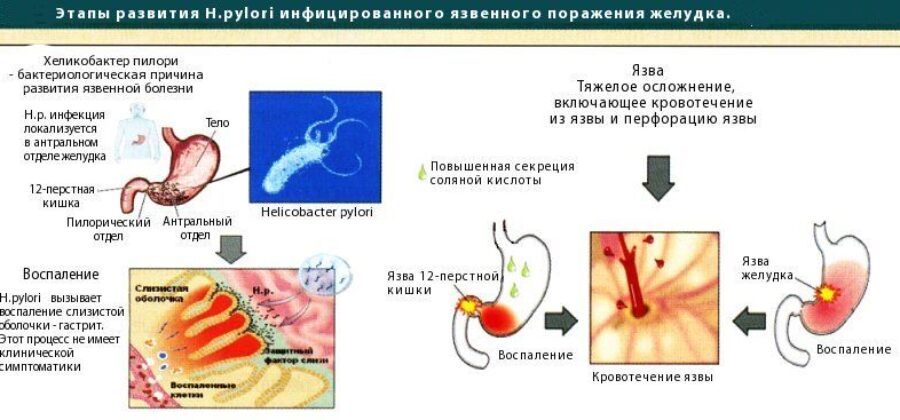 Хеликобактер в желудке у взрослых. Стадии развития язвенной болезни желудка. Язвенная болезнь желудка хеликобактер. Язвенная этиология хеликобактер пилори. Патогенез язвенной болезни желудка хеликобактер пилори.