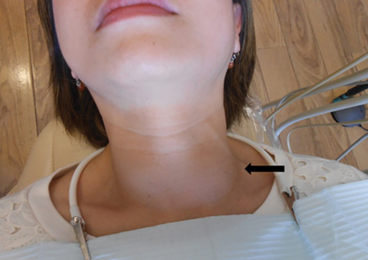 Зоб щитовидной железы операция. Лимфоузлы на шее и щитовидная железа. Шрам после операции на щитовидной железе. Припухлость щитовидки.