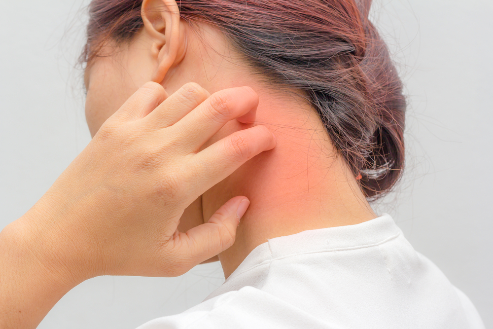 Чешется затылок причины. Аллергическая реакция на шее. Аллергическое покраснение кожи. Кожные заболевания на шее.