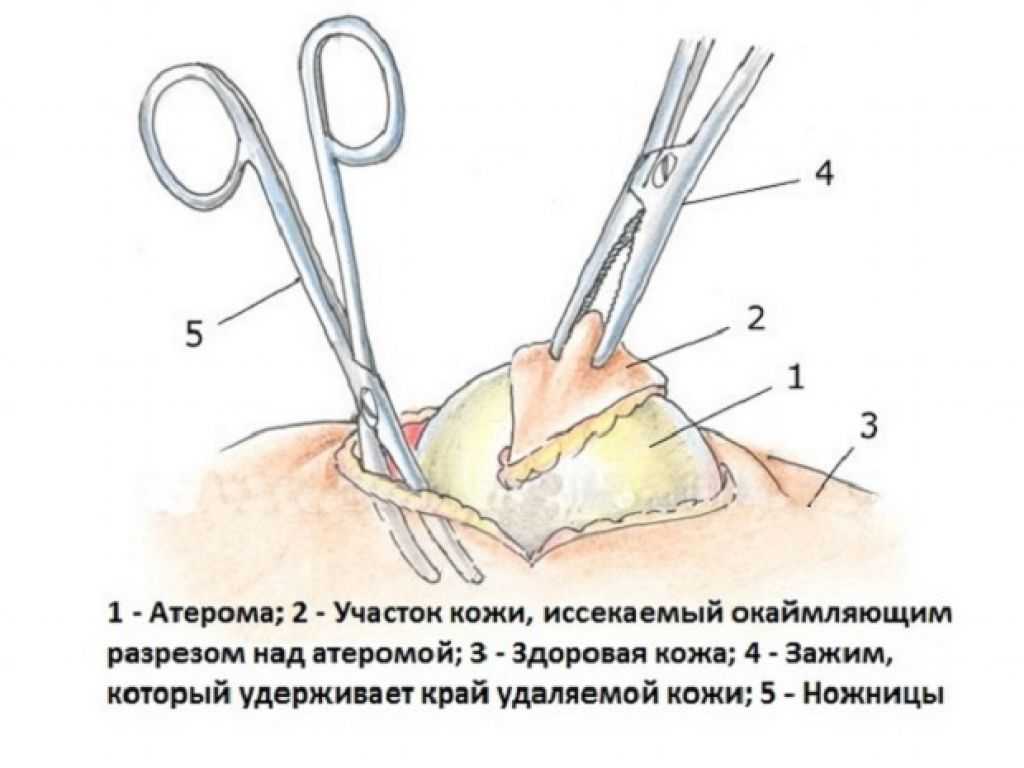 Гнойная капсула. Атерома схема операции. Атерома киста сальной железы. Иссечение липомы ход операции.