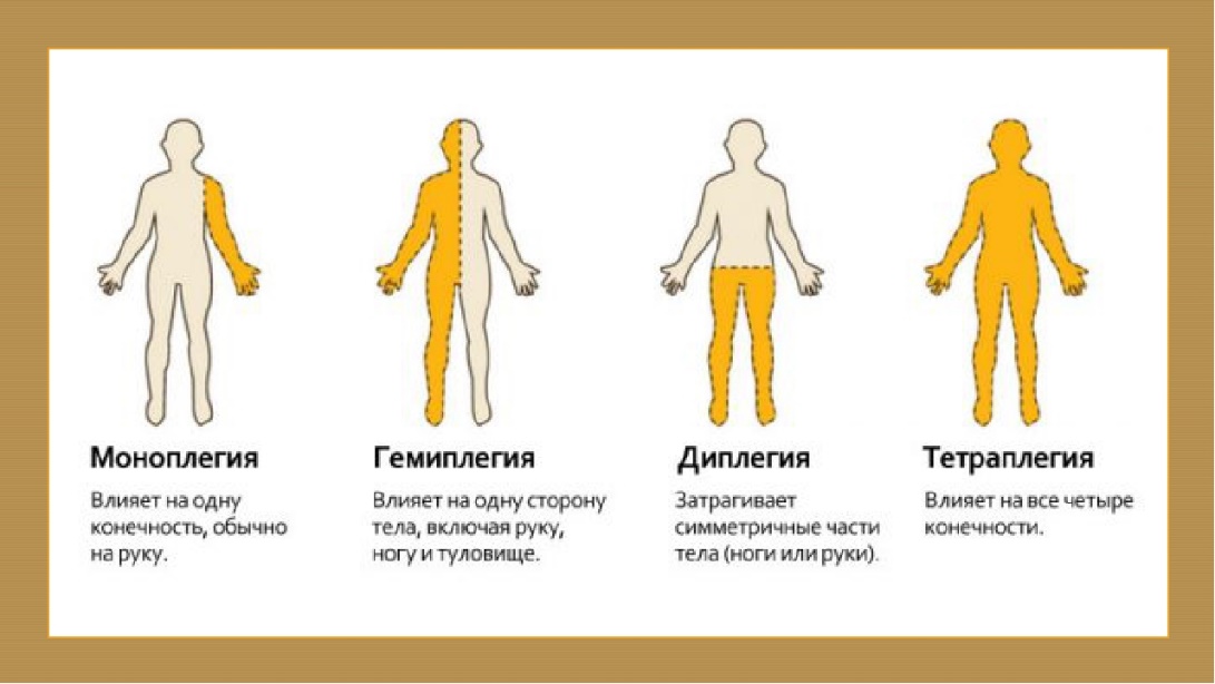 Рассмотрите изображение человека с определенным заболеванием что это за заболевание