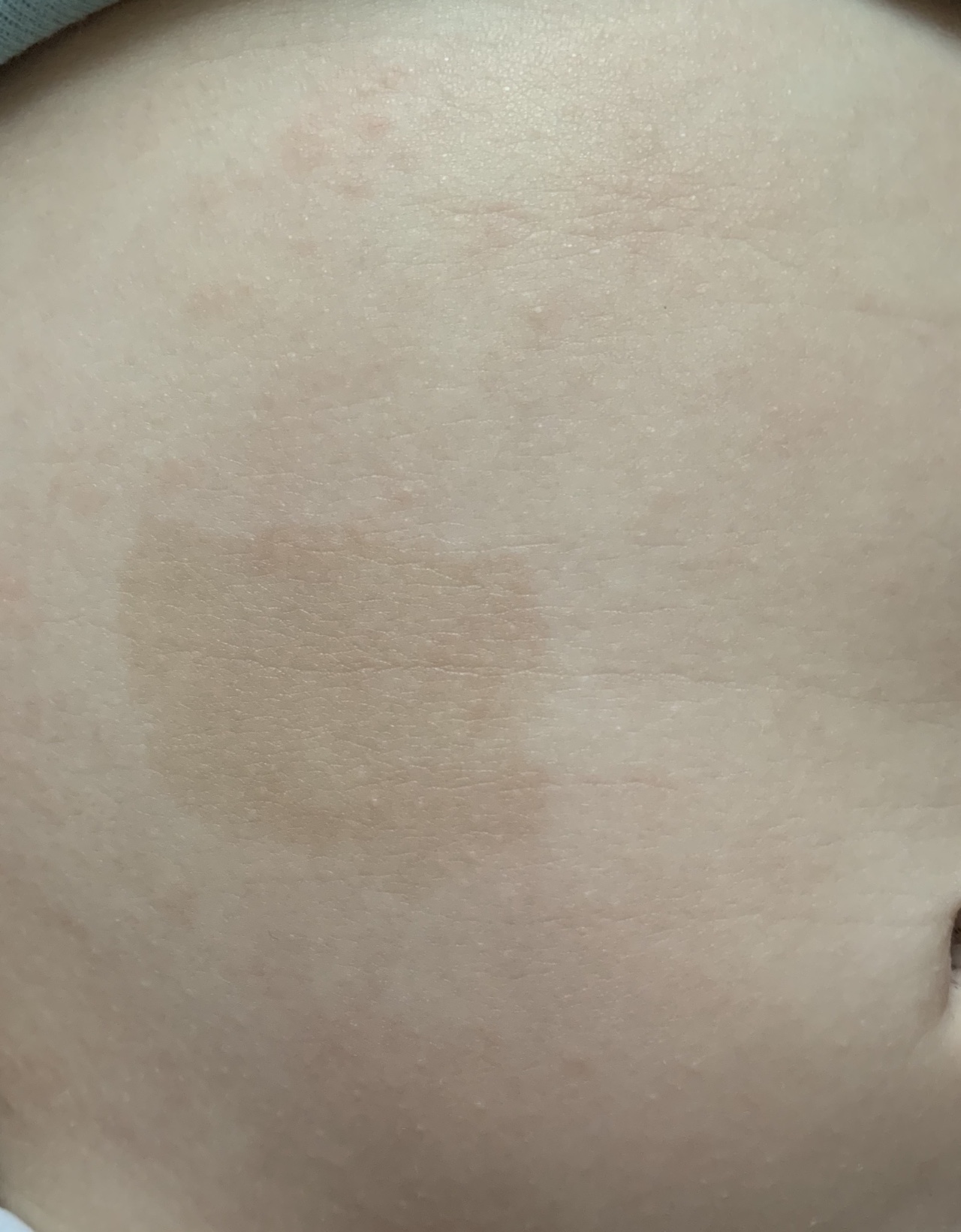 светло коричневые пятна на груди у женщин фото 87