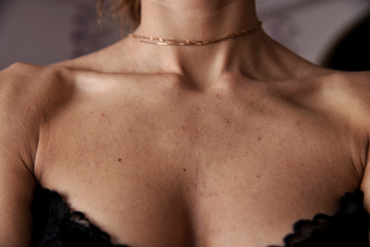 сыпь на груди и шее у женщин причины (120) фото