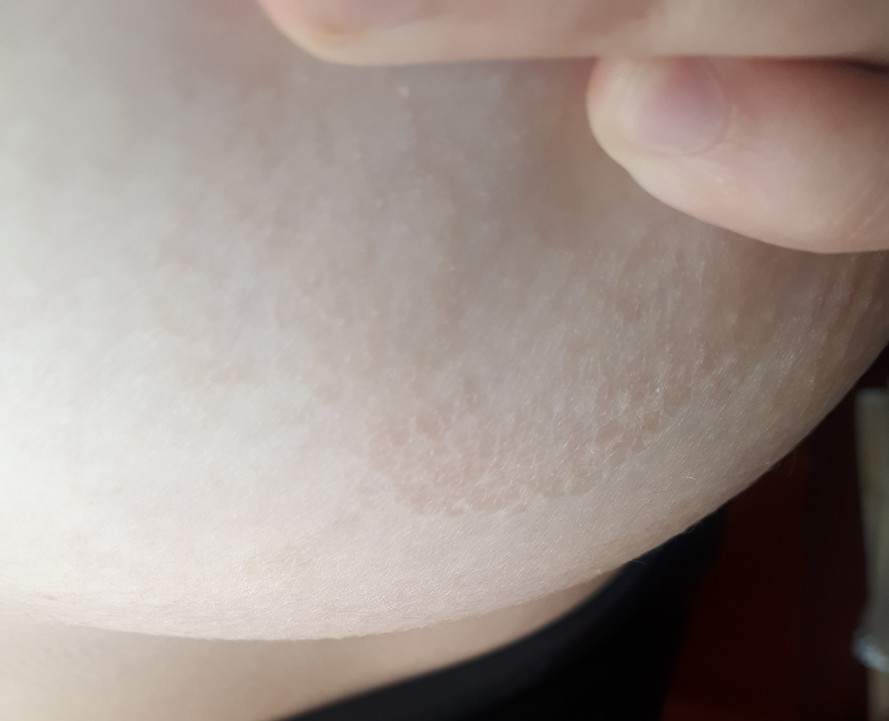 белые пятна на груди у женщин фото 15