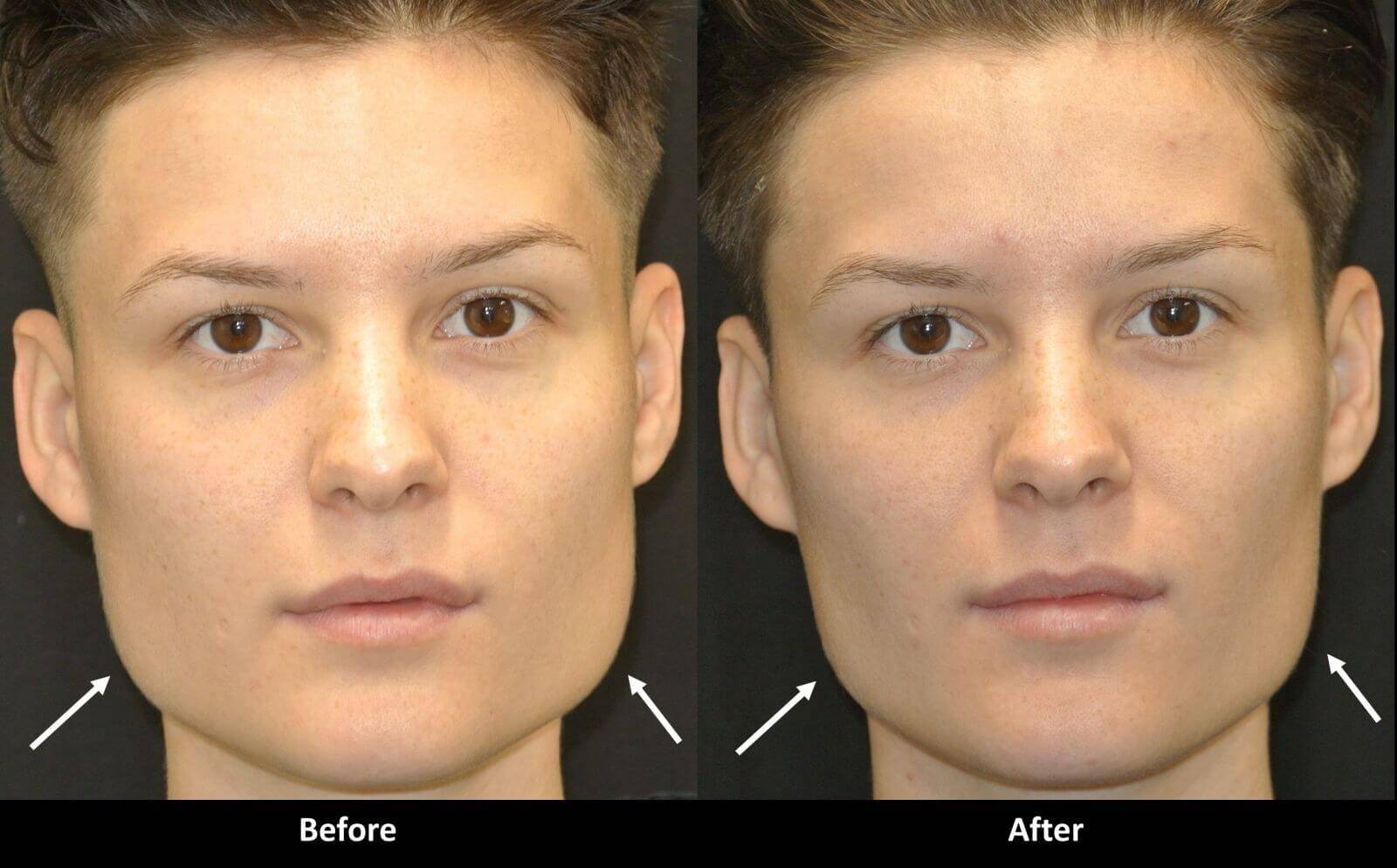 Асимметрия лица после ботокса фото до и после