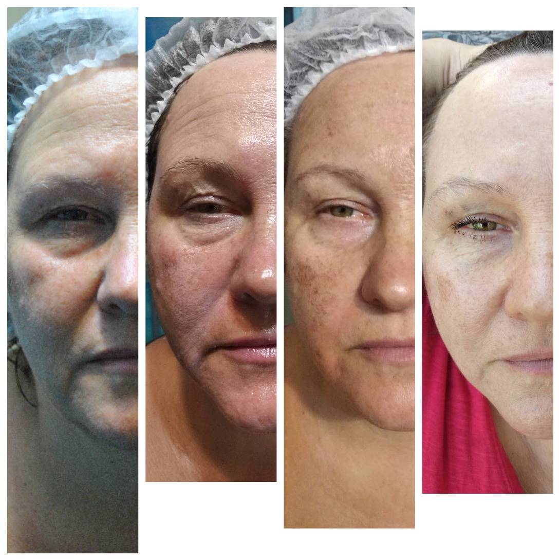 Ретиноловый пилинг после. Срединный пилинг ретиноловый. Желтый химический пилинг. Химический пилинг для лица до и после.