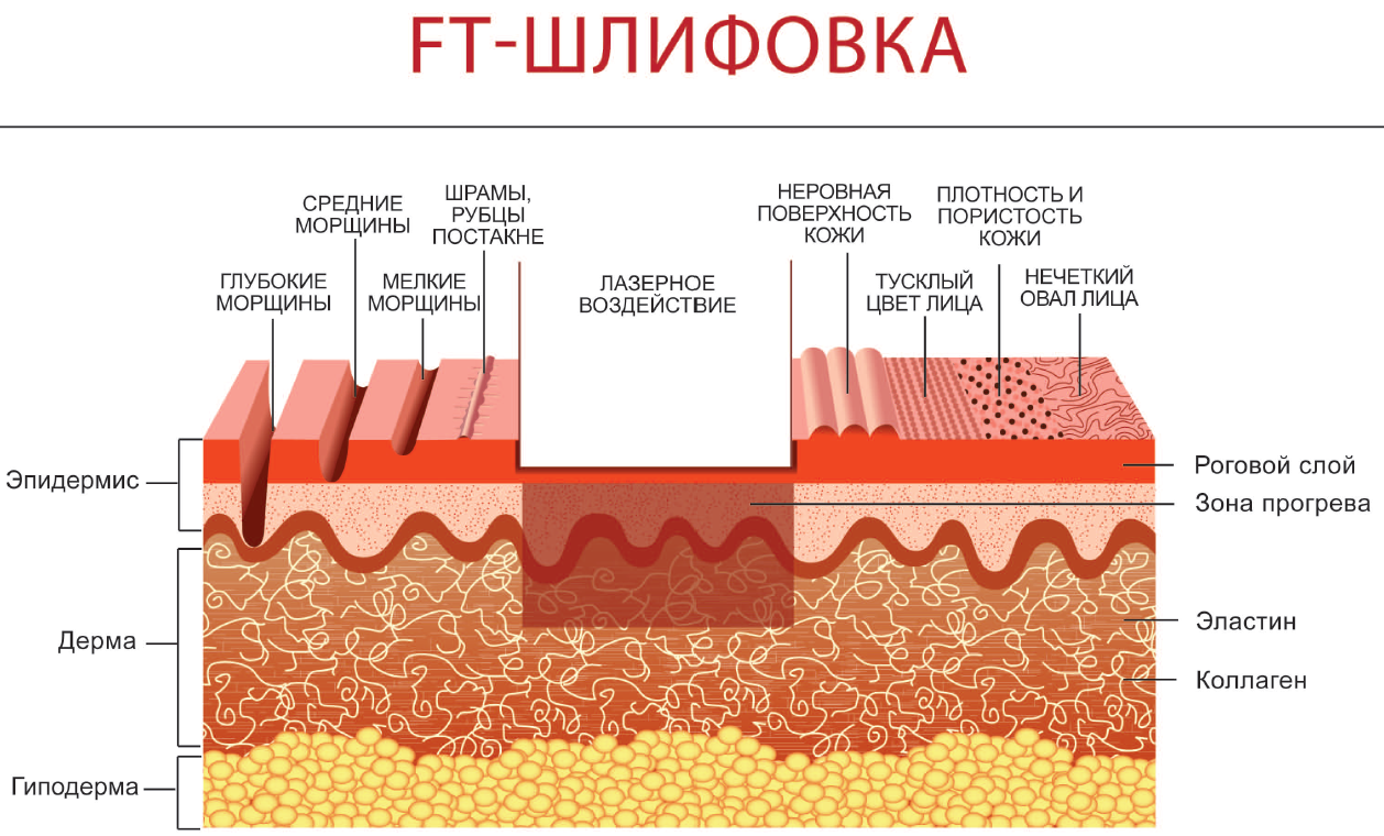 Слои можно. Глубина проникновения co2 лазера. Глубина проникновения со2 лазера. Лазерная шлифовка схема со2.