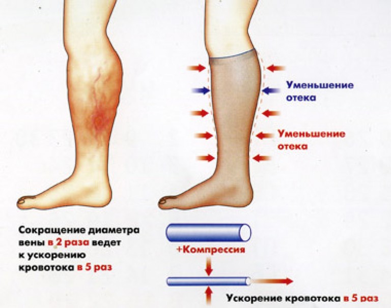 Лимфостаз Ног Картинки