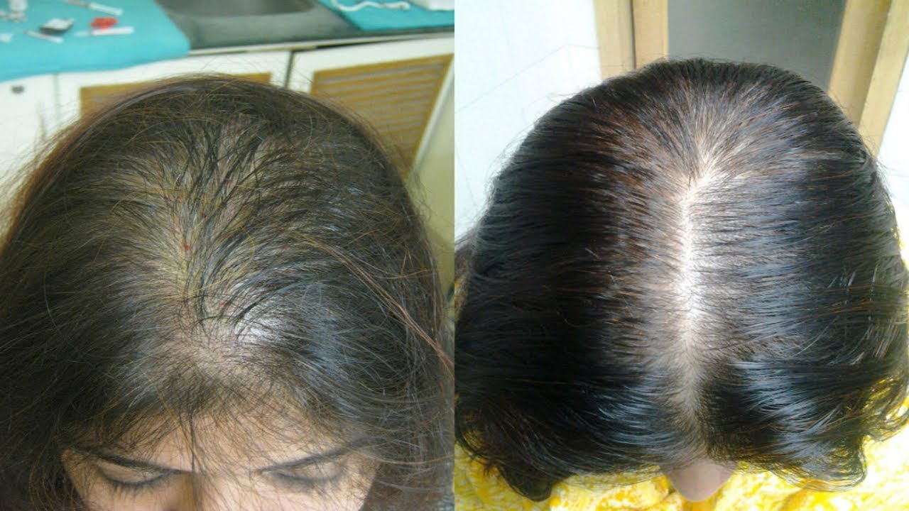 Причину выпадения волос после 40. Волосы после облысения. Выпадение волос алопеция у женщин.