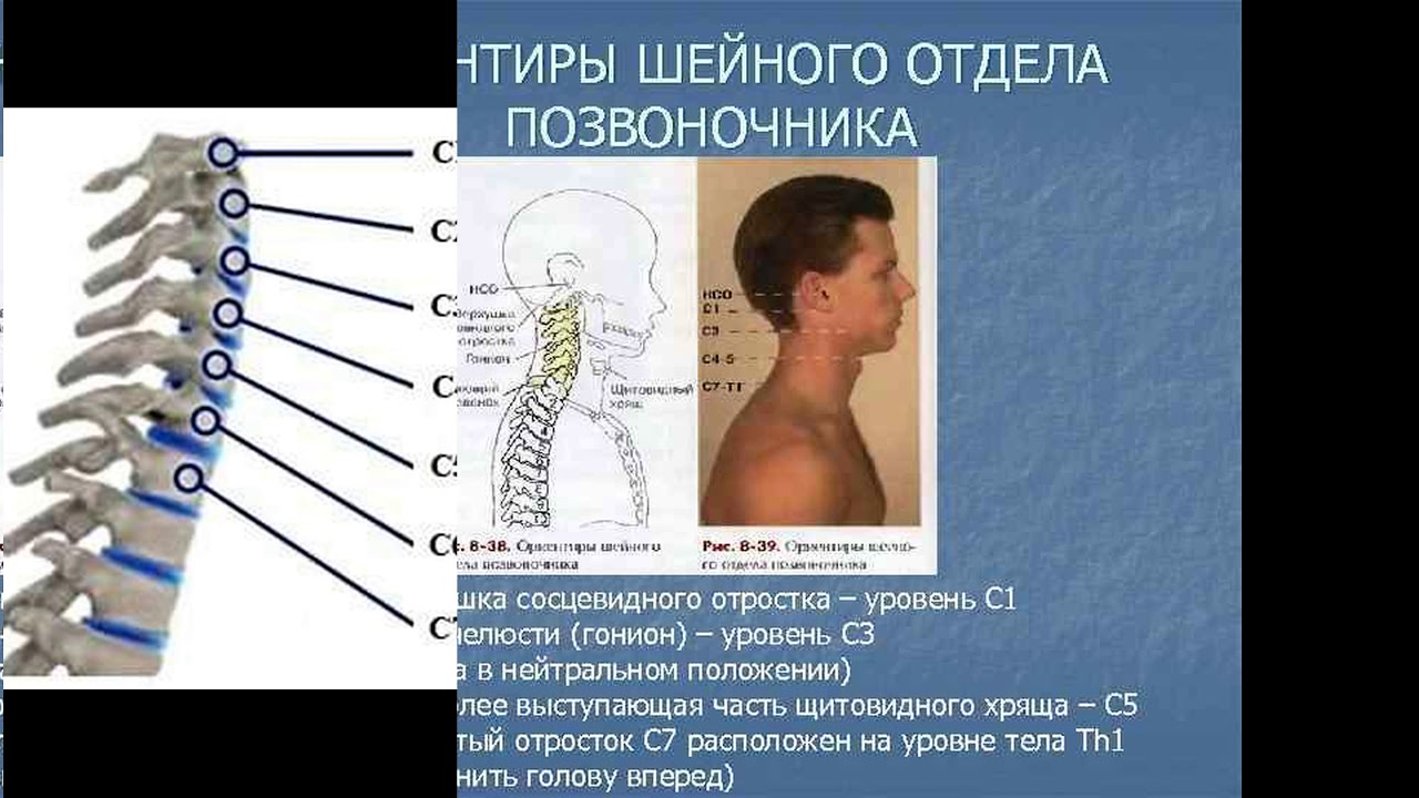 В позвоночнике выделяют отделы. С6 шейного отдела позвоночника. 6 Шейный позвонок. Шейный отдел позвонка с5 схема. 6 И 7 шейные позвонки.