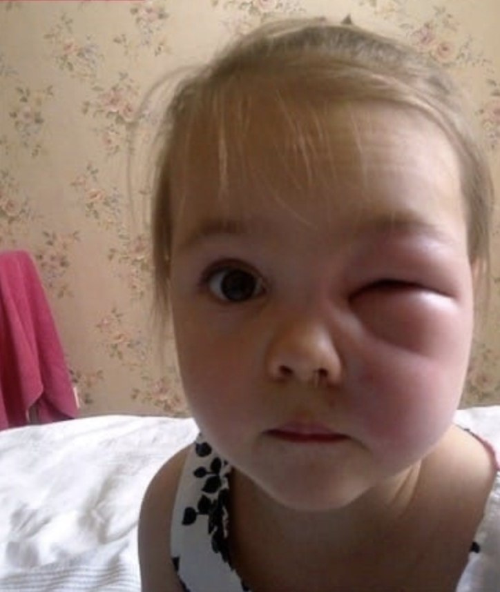 3 отек. Ребенка укусила мошка в глаз.