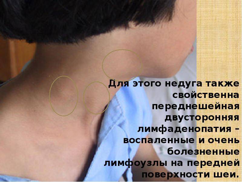 Температура и лимфоузлы на шее у ребенка. Лимфоузел на шее расположение.