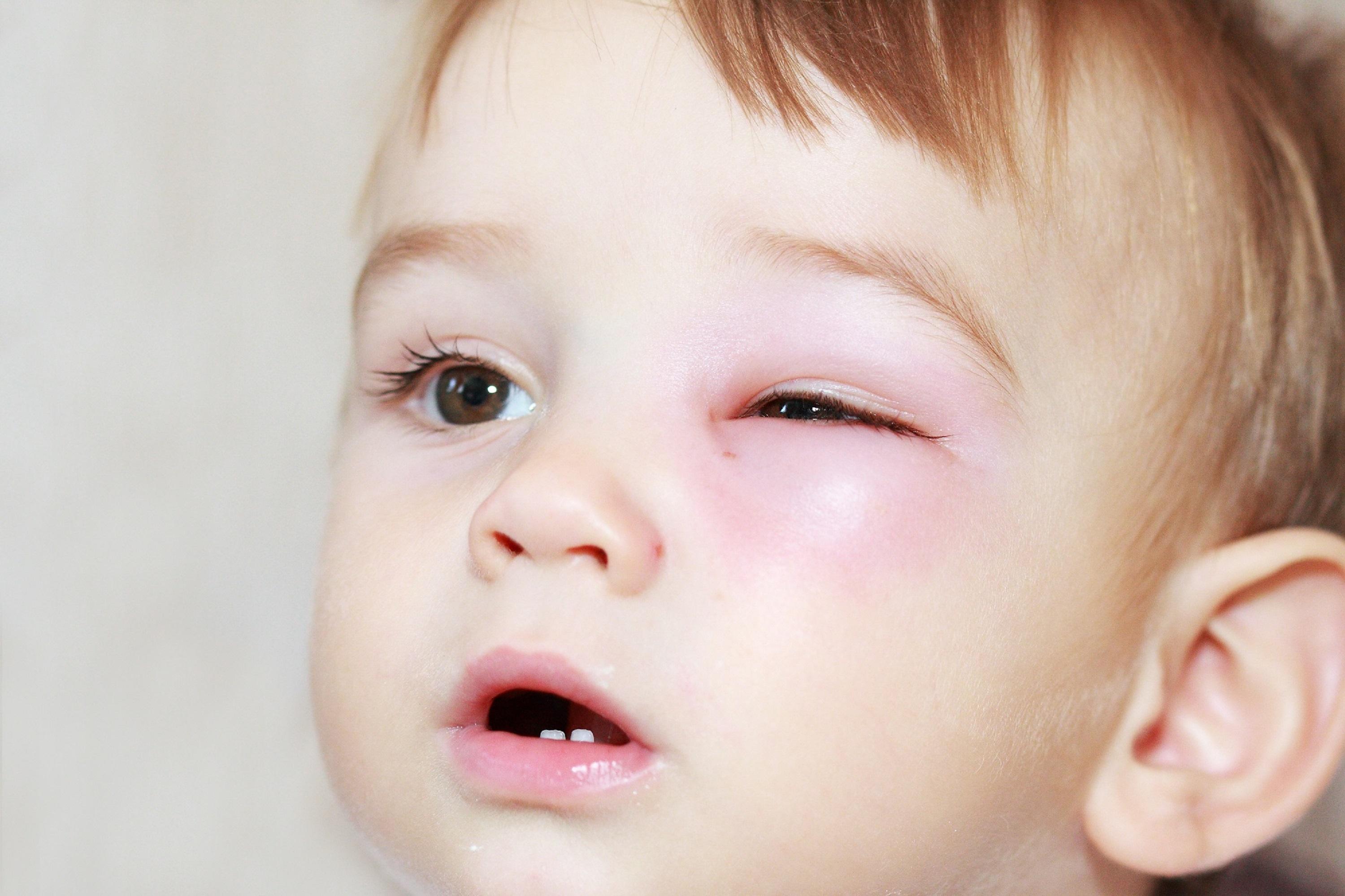 Припухлость у мальчика. Аллергический отек века у ребенка. Конъюнктивит у ребенка отек под глазом.