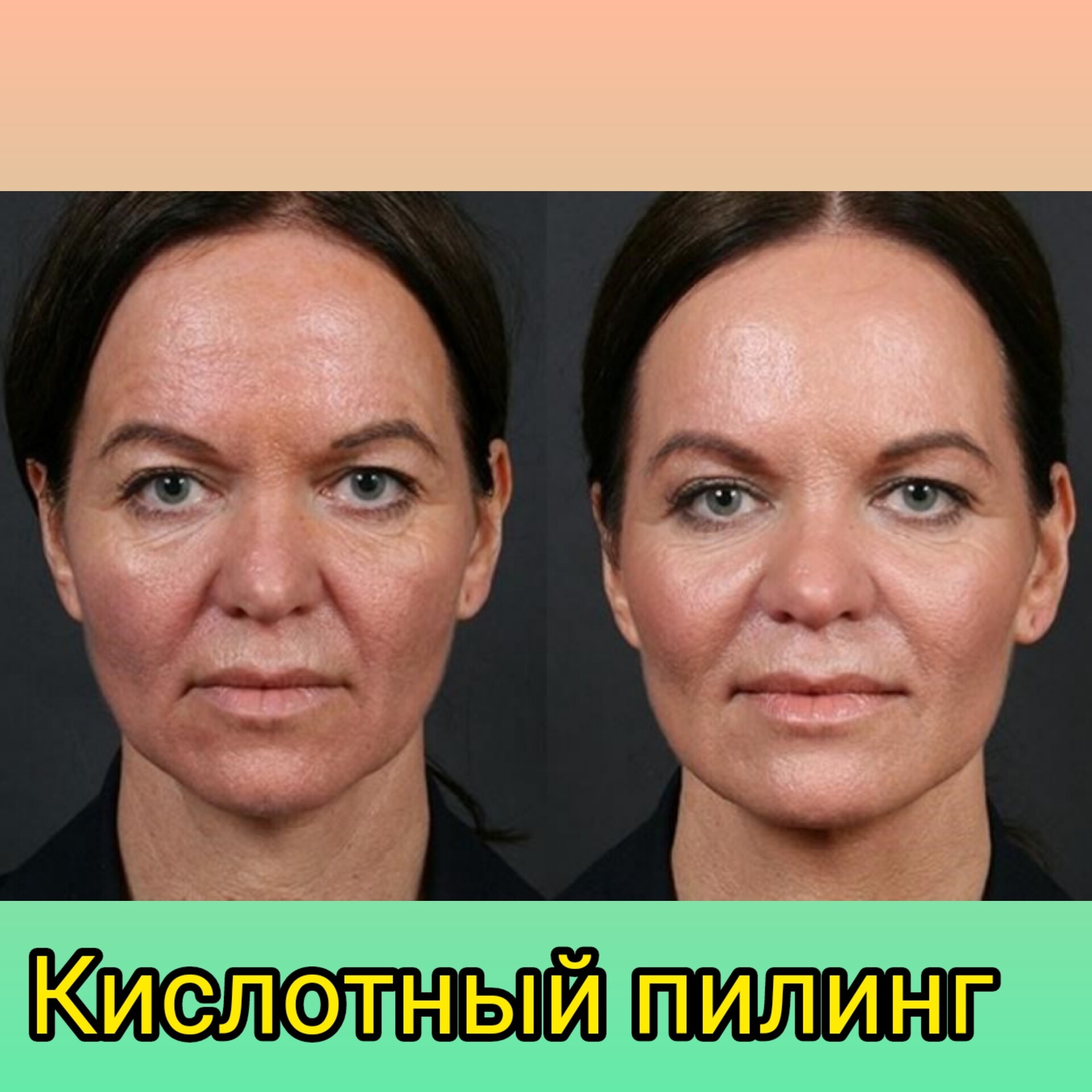 Эффект после лечения. ТСА 20 пилинг. Кислотный пилинг для лица до и после.