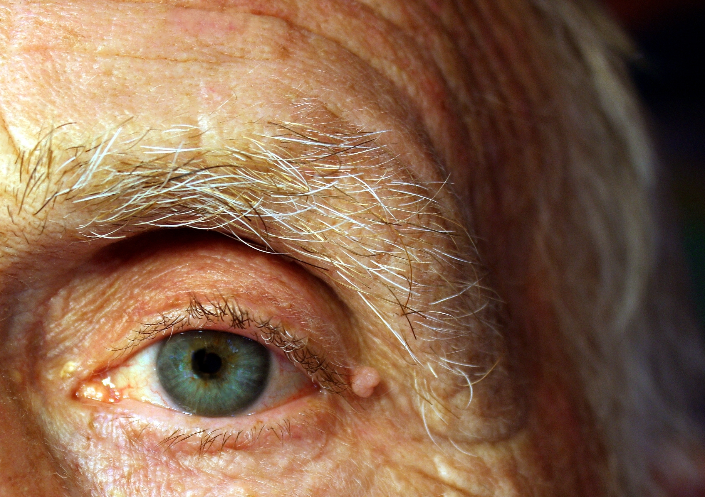 Заболеваниями заболеваний глаз появиться. Старческая(сенильная)катаракта. Заболевания глазных век. Возрастные заболевания глаз.