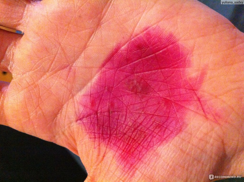 Огромное пятно. Малиновые пятна на коже. Розовое пятнышко на руке.