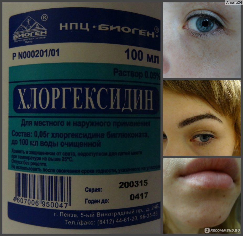 Аллергия на хлоргексидин