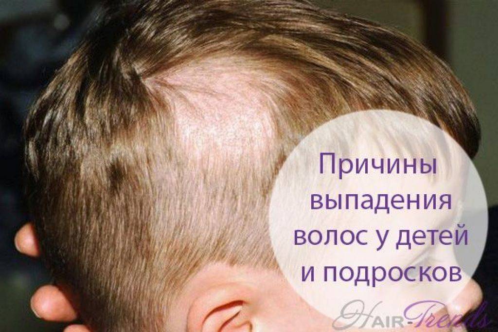 Причины выпадения волос у подростка. Гнездная алопеция у детей. Плешивость на голове у ребенка. Почему у ребенка выпадают волосы.