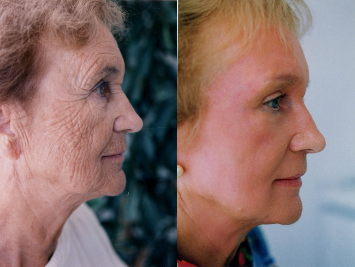 Процедура для лица после 60. Омоложение лица. Омоложение кожи лица. Омоложение лица до и после. Стареющая кожа.