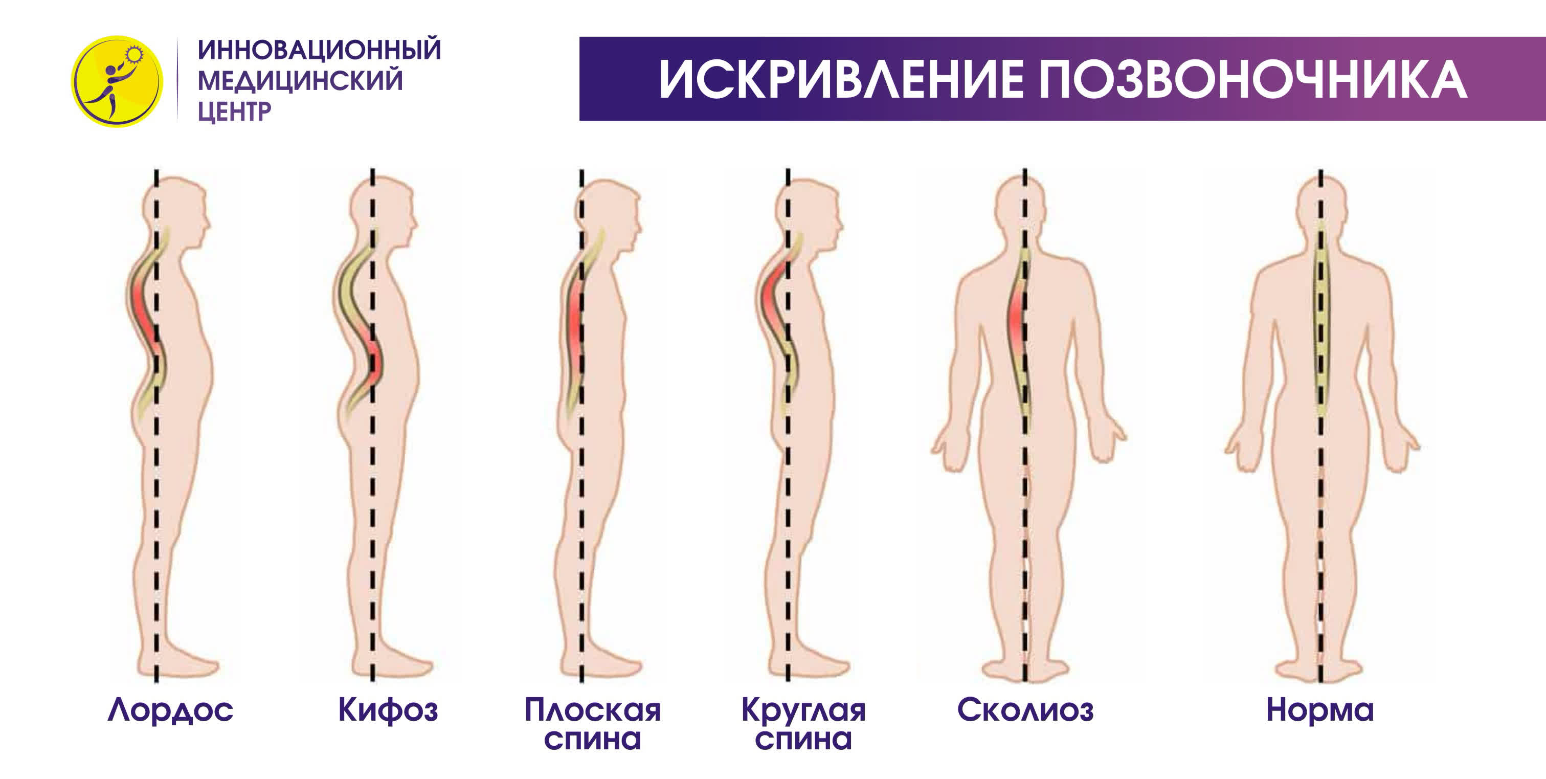 Какие искривления позвоночника. Осанка лордоз кифоз сколиоз. Деформации позвоночника кифоз лордоз сколиоз. Деформации позвоночника ( сколиоз, лордоз, гиперкифоз). Сколиоз кифоз лордоз остеохондроз.