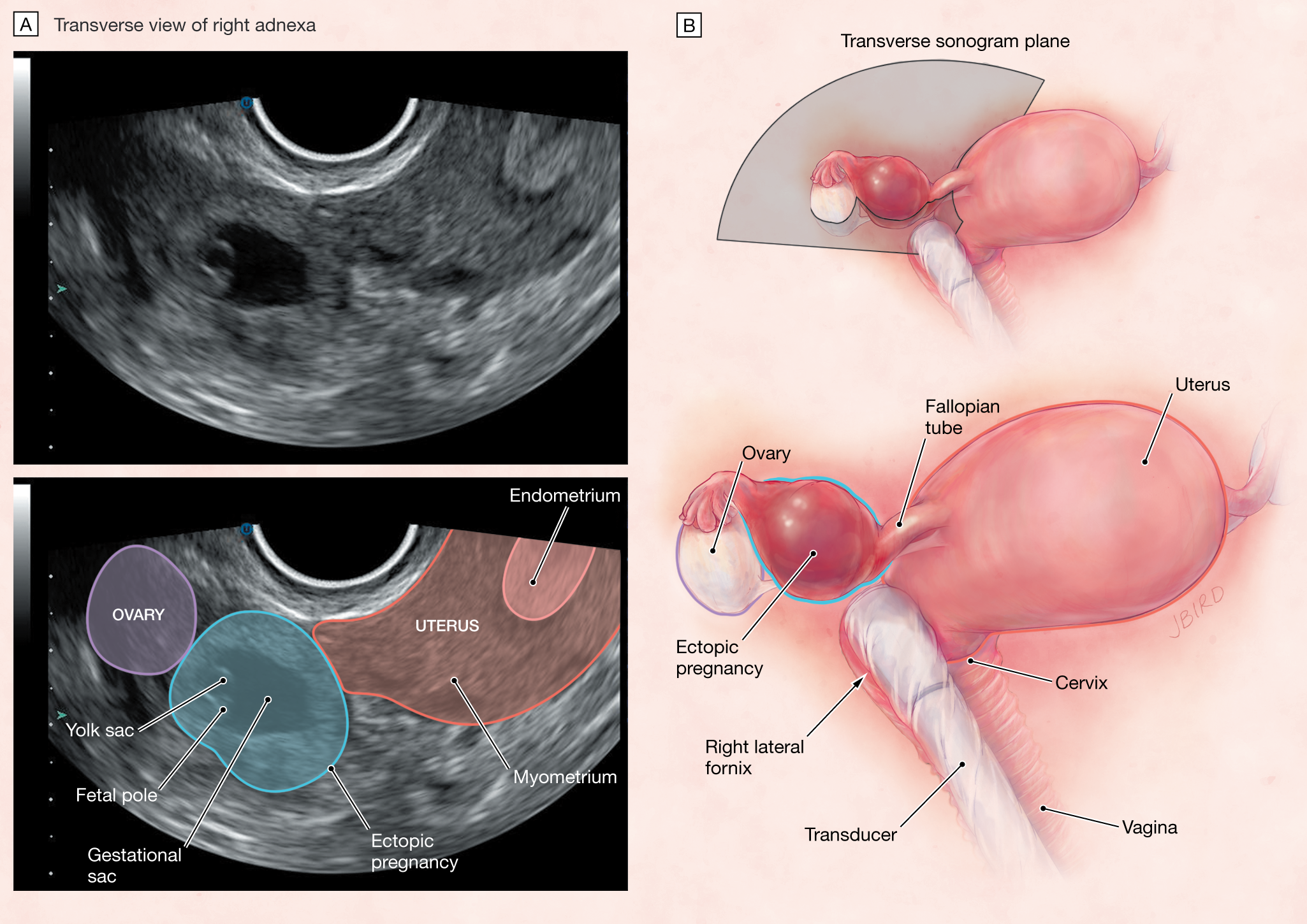 Трубная внематочная беременность