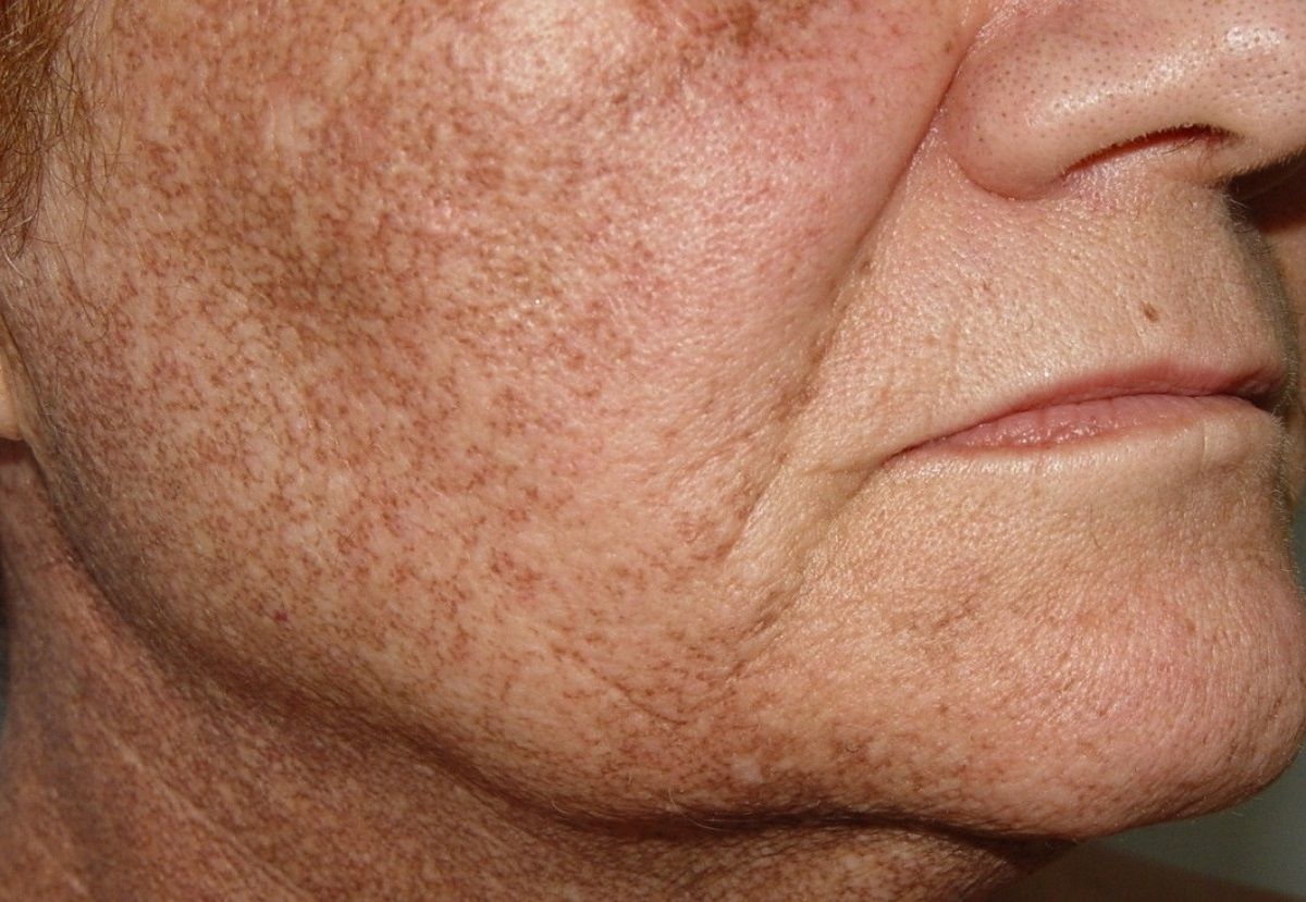 Пигментные пятна на лице у мужчин причины фото