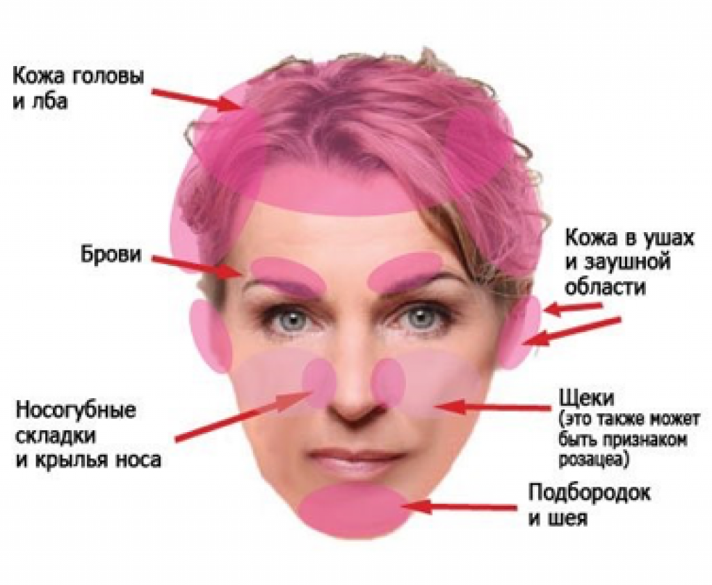 Почему красное лицо постоянно у женщины. Себорейный дерматит на лице. Себорейный дерматит кожи лица. Себорейный дерматит локализация.