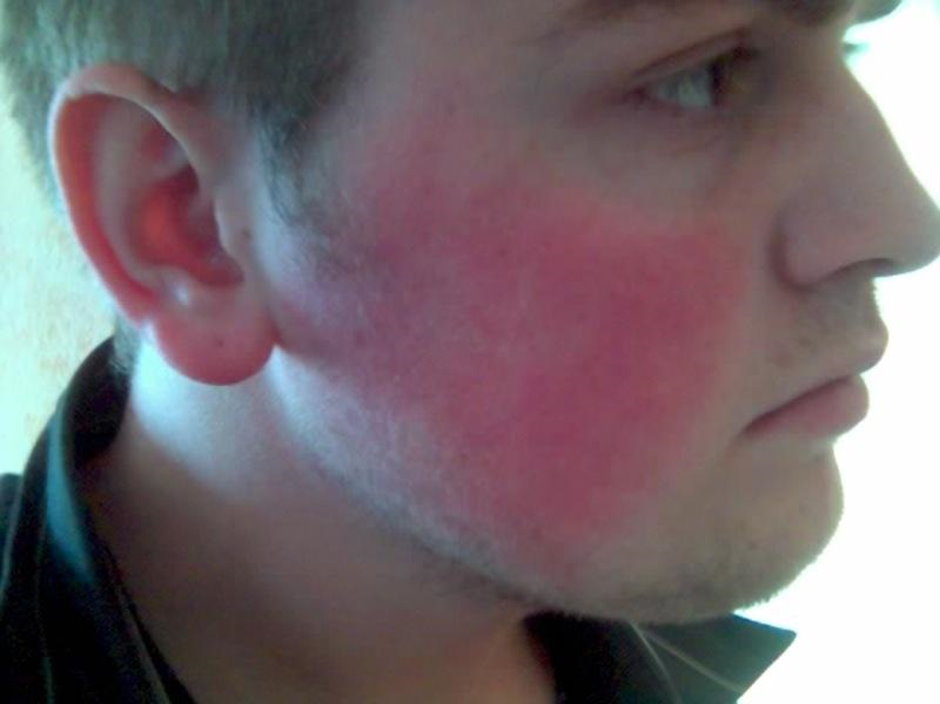 Почему щеки у мужчин. Красныйпятно на лице.