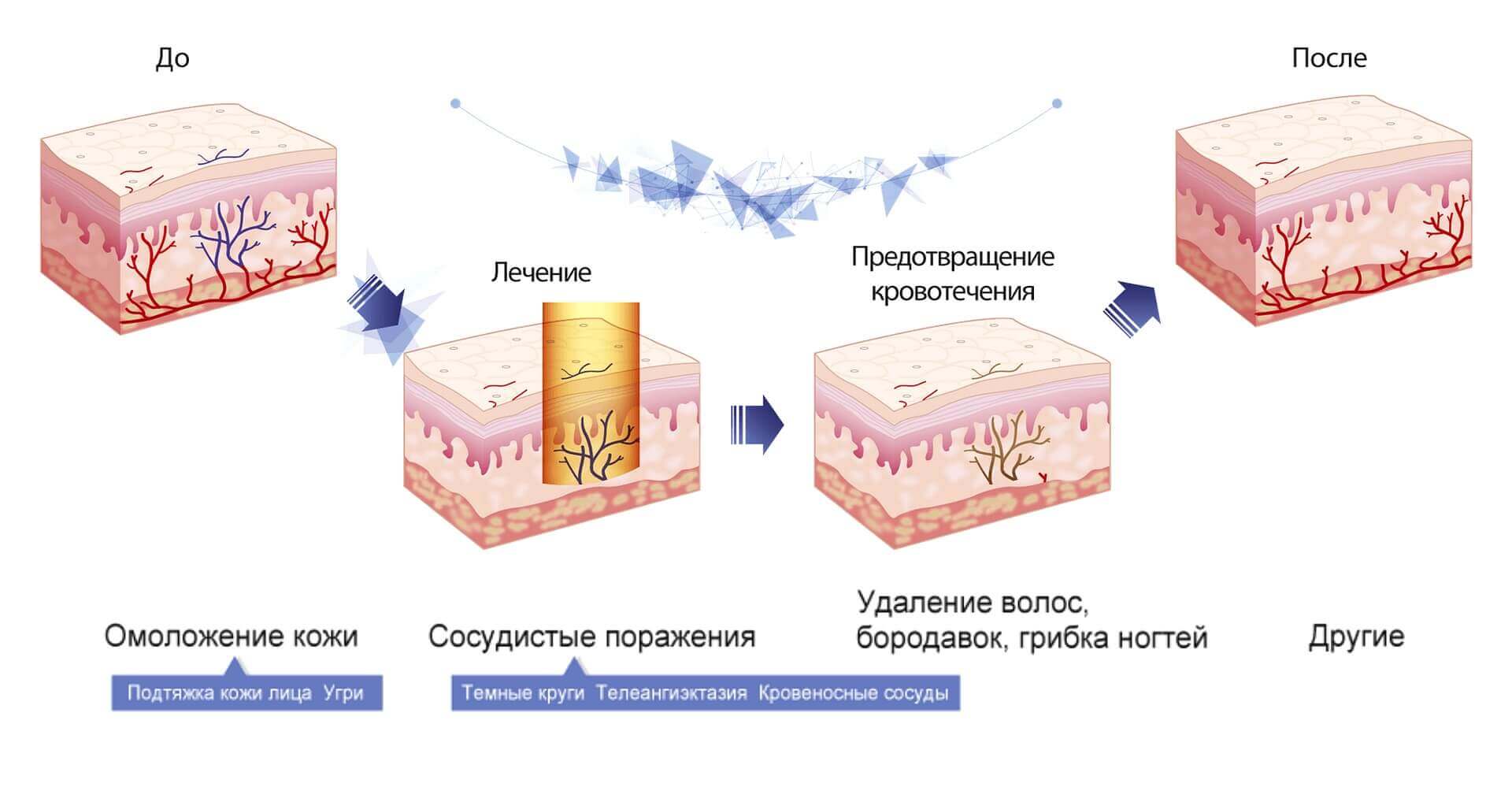 Лазерное воздействие на кожу skinlift ru