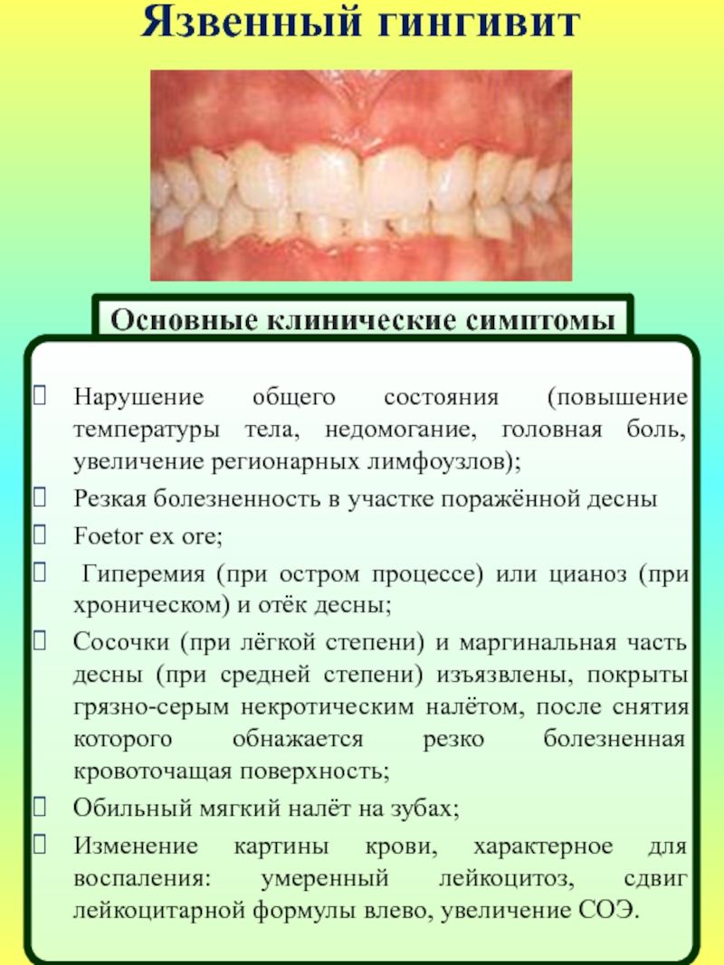 Признаки лечения зубов. Гидантоиновый гингивит это. Некротически язвенный гингивит. Некротически язвенный гингив т. Острый язвенно-некротический гингивит Венсана.