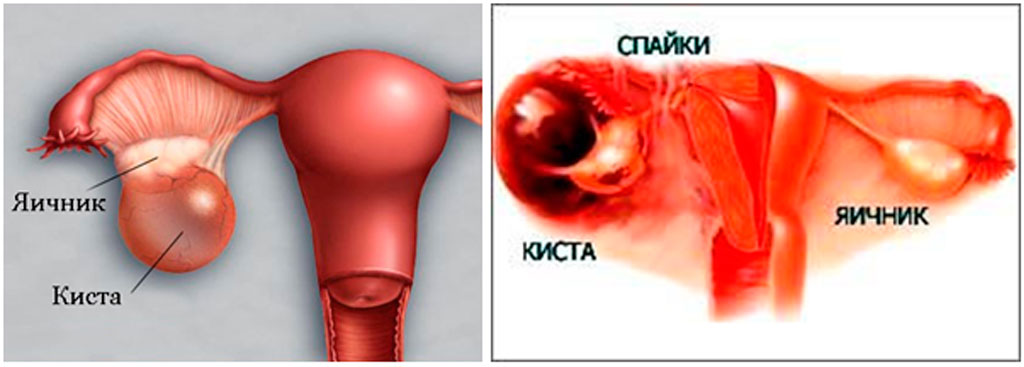 Спайки на яичниках картинки