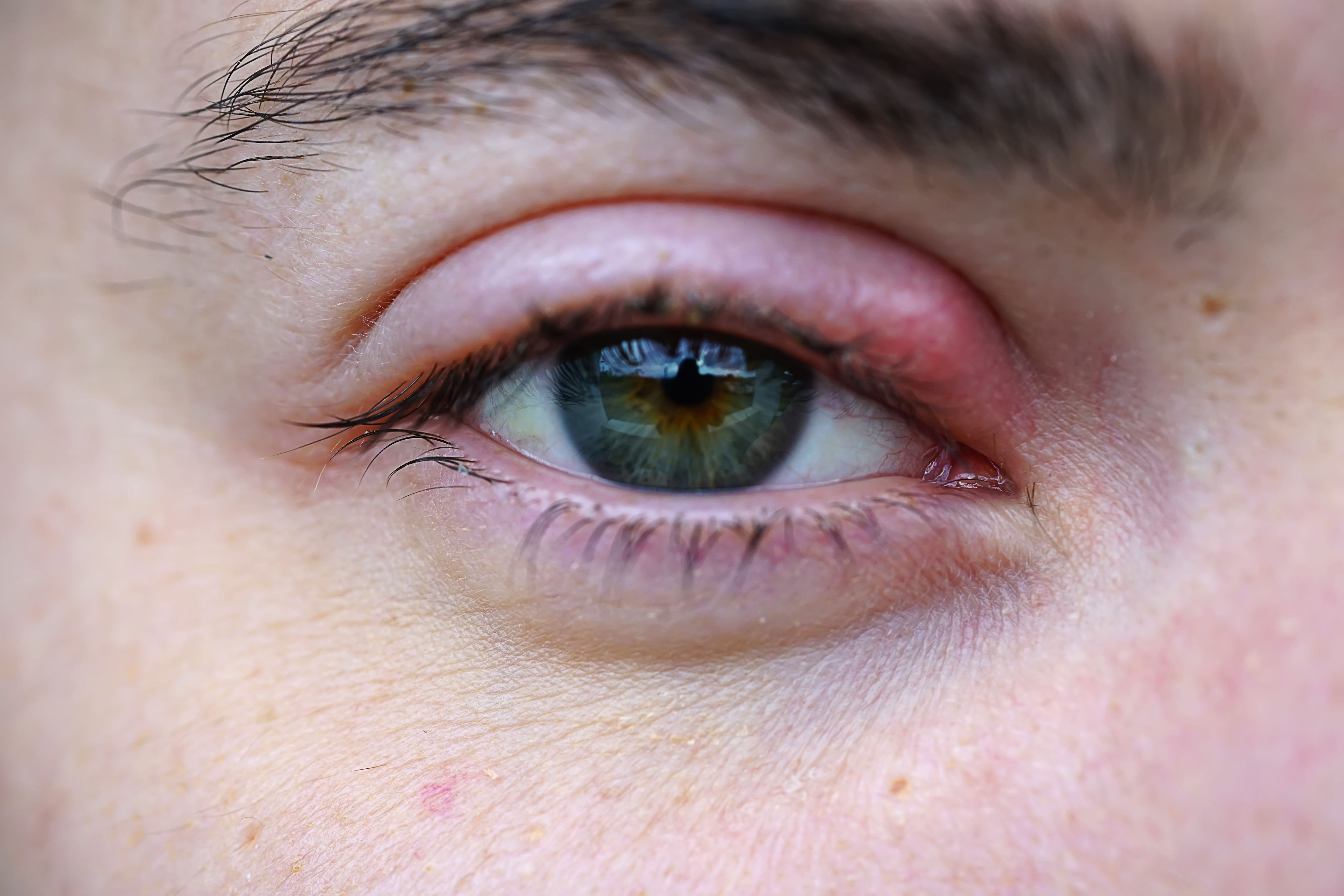 Причина боли под глазами. Блефарит конъюнктивит ячмень. Токсико аллергический блефарит.